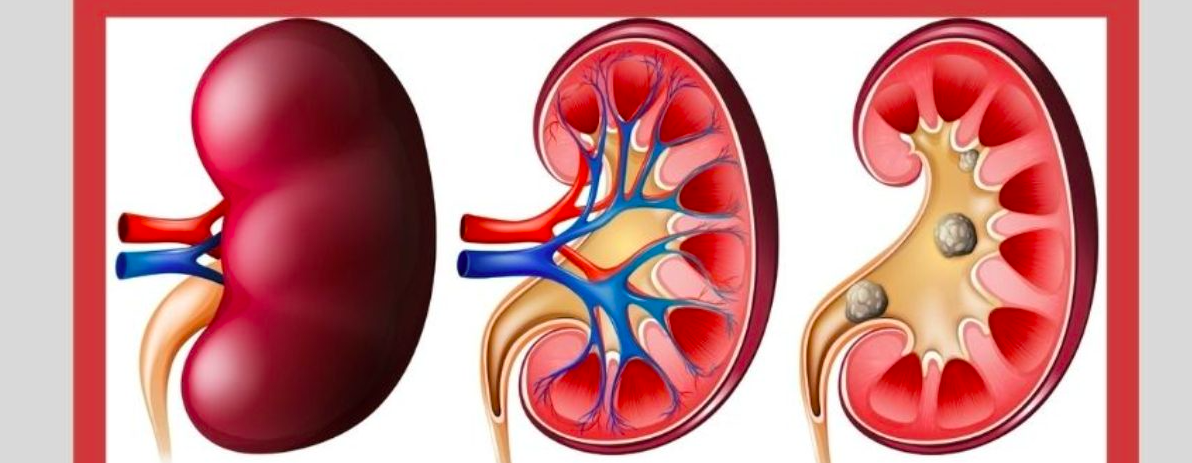 गुर्दे की पथरी के लिए डाइट चार्ट: क्या खाएं, क्या न खाएं